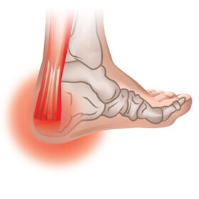 achilles-tendonitis