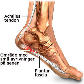 plantarfasciitt