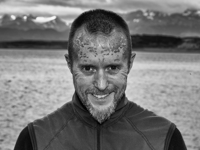 Sola i Antarktis var sterk, noe Frode fikk synlig bevis på (privat foto).