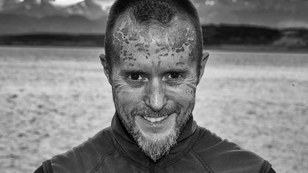 Sola i Antarktis var sterk, noe Frode fikk synlig bevis på (privat foto). 