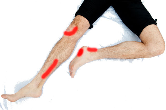 Løpskadene kan melde seg på forskjellige steder, f.eks. i kne, legg, hæl og fot.