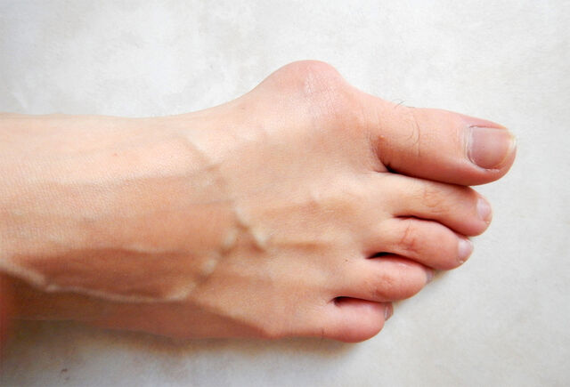 Stortå til besvær: Hallux valgus-plager lar seg vanskelig trene vekk, og om ikke innleggssåler eller romslige sko hjelper, kan operativ behandling vurderes. (Foto: Lamiot, Wikipedia)