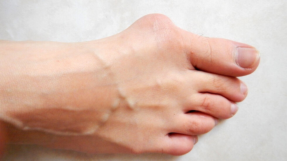 Stortå til besvær: Hallux valgus-plager lar seg vanskelig trene vekk, og om ikke innleggssåler eller romslige sko hjelper, kan operativ behandling vurderes. (Foto: Lamiot, Wikipedia)