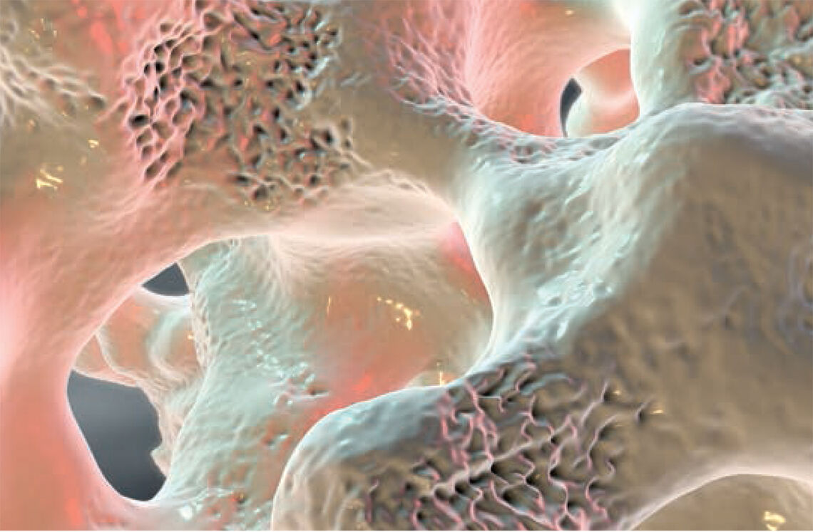 Nedsatt beintetthet: Vi ser svampete beinvev påvirket av osteoporose. (Foto: iStockphoto)  