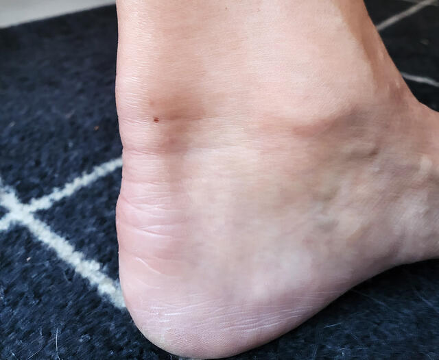 Skade etter karate: Slik ser den vonde akillessenen ut. (Foto: privat)