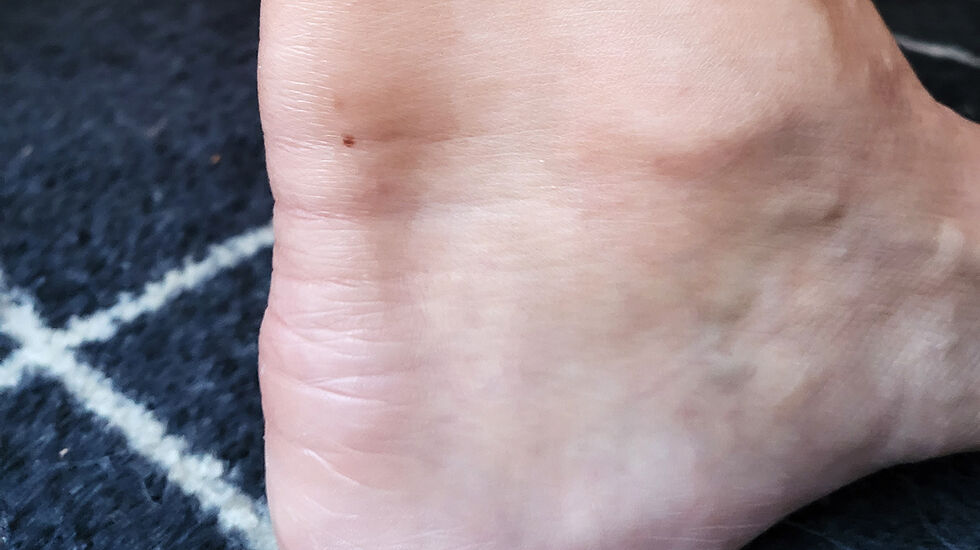 Skade etter karate: Slik ser den vonde akillessenen ut. (Foto: privat)