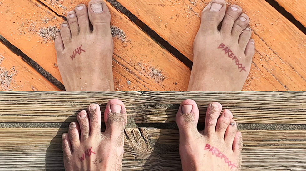 Før og etter: Det øverste bildet er tatt før Christina begynte å trene stortåa som følge av en plantar fascitt-skade i 2020. Det nederste bildet viser foten av i dag – etter opptreningen. (Foto: Christina Forstrønen Bruarøy)