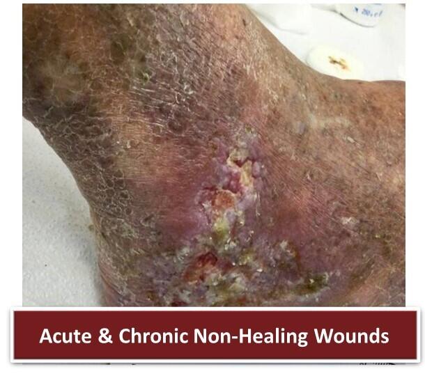 Acute & Chronic Wounds1