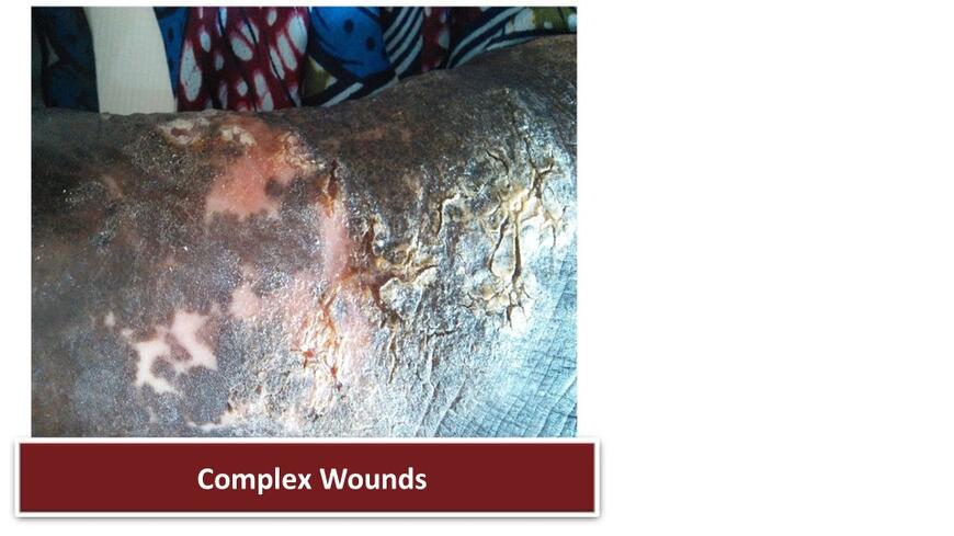 Complex Wound Leg 2