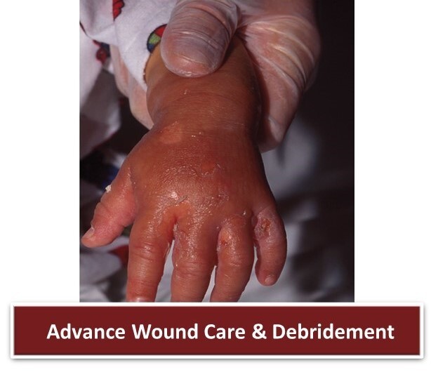 Advance Wound Care & Debridement  - 010524.jpg