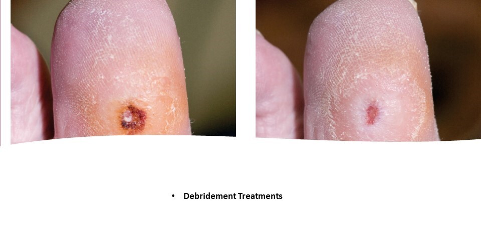 Debridement Wound Management - 010524.jpg