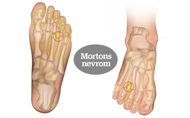 Mortons nevrom: Smertene skyldes en hoven og irritert nerve, som oftest mellom tredje og fjerde tå. (Foto: iStockphoto)
