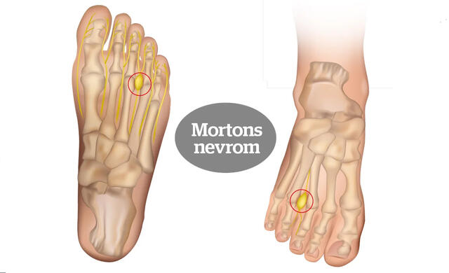 Mortons nevrom: Smertene skyldes en hoven og irritert nerve, som oftest mellom tredje og fjerde tå. (Foto: iStockphoto)