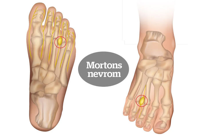 Mortons nevrom: Smertene skyldes en hoven og irritert nerve, som oftest mellom tredje og fjerde tå. (Foto: iStockphoto)