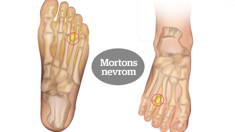 Mortons nevrom: Smertene skyldes en hoven og irritert nerve, som oftest mellom tredje og fjerde tå. (Foto: iStockphoto)